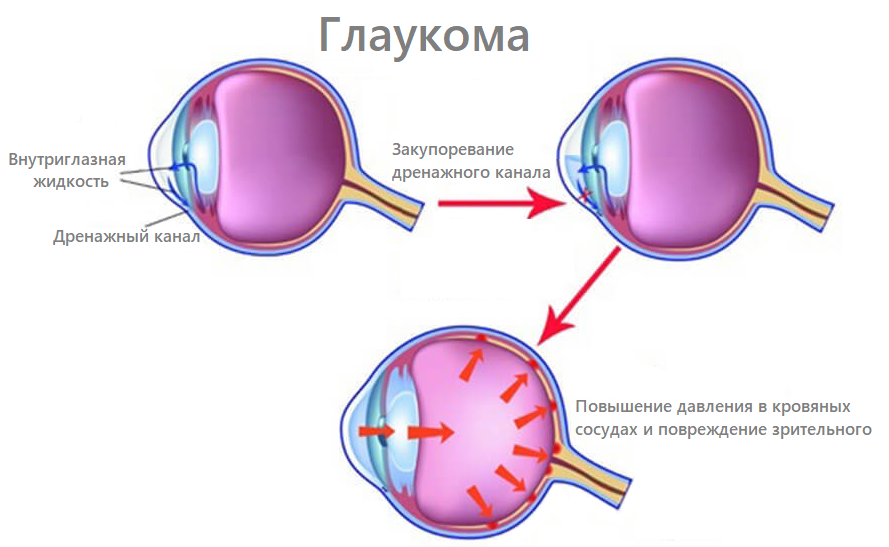 глаукома