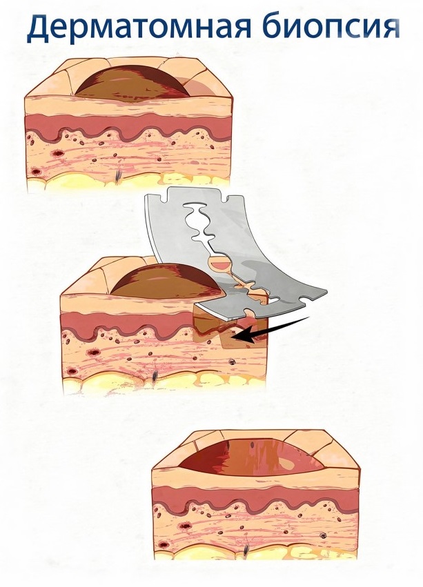 Биопсия новообразований кожи