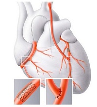 На схематичном сердце изображены области операционного вмешательства 