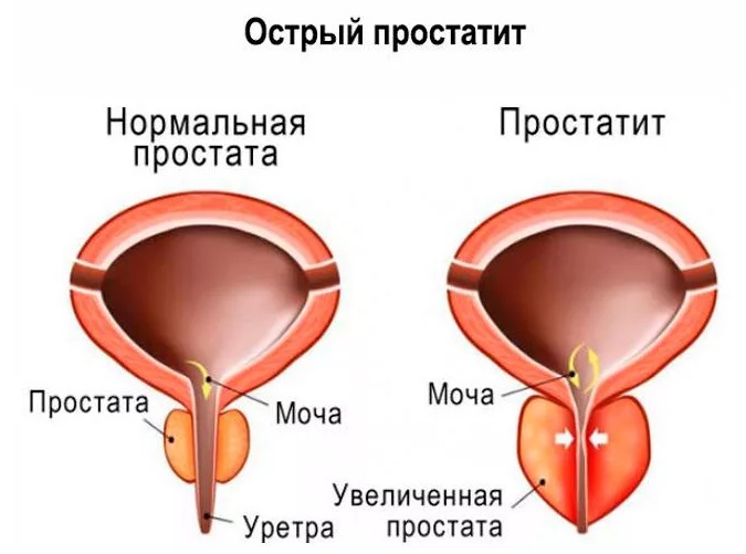 простата у мужчин симптомы фото