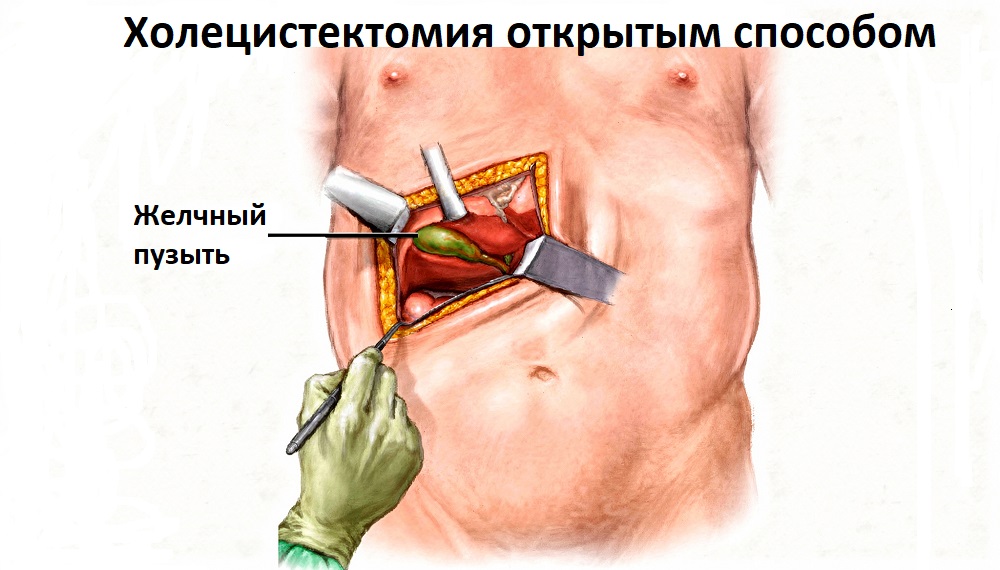 Операция по удалению желчного пузыря