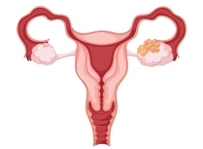 рак яичников первые признаки и симптомы рак яичников первые признаки и симптомы