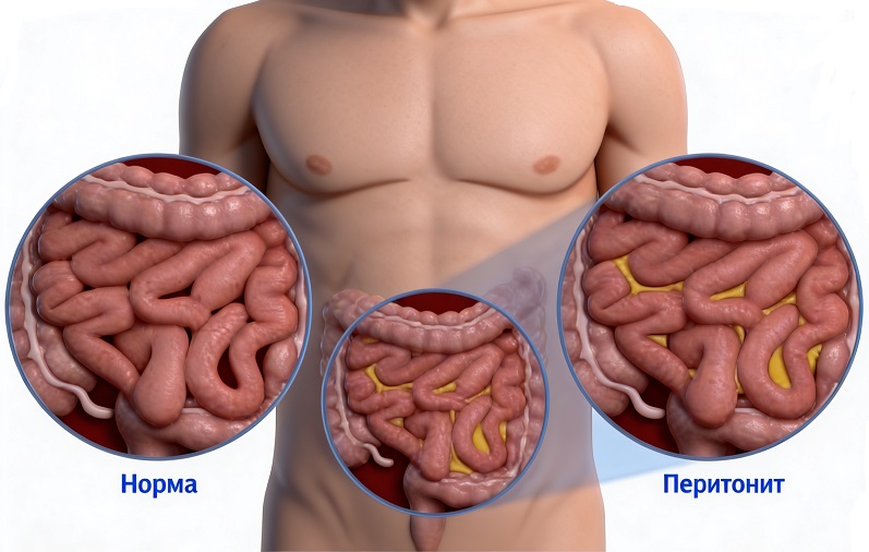 Перитонит - симптомы и признаки
