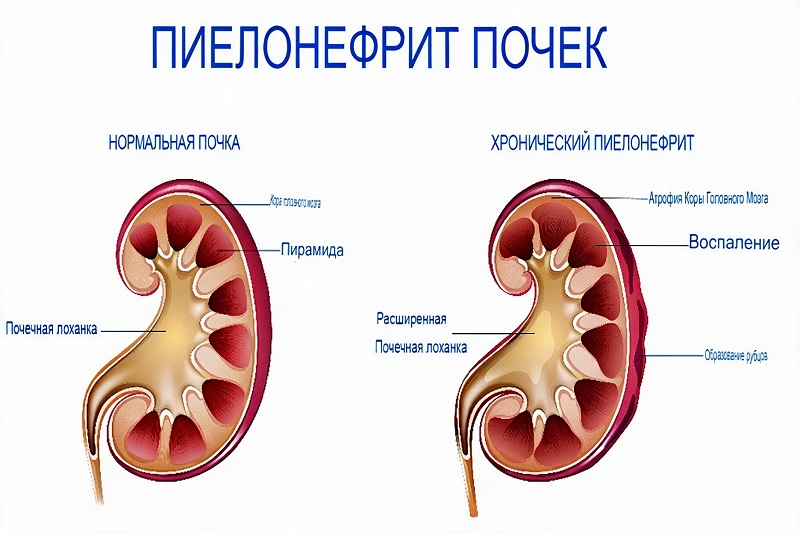Пиелонефрит почек