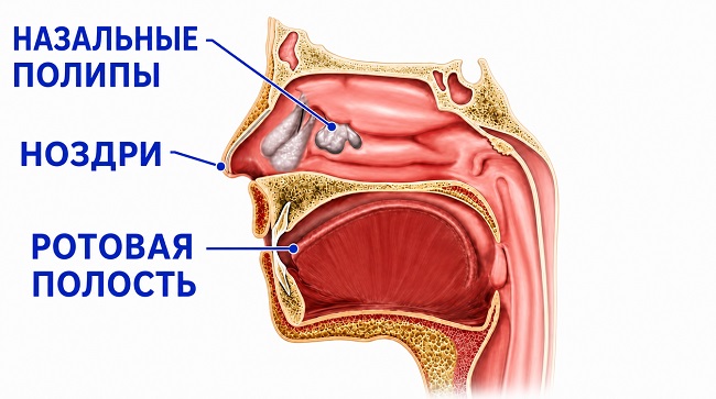 Хронический полипозный риносинусит