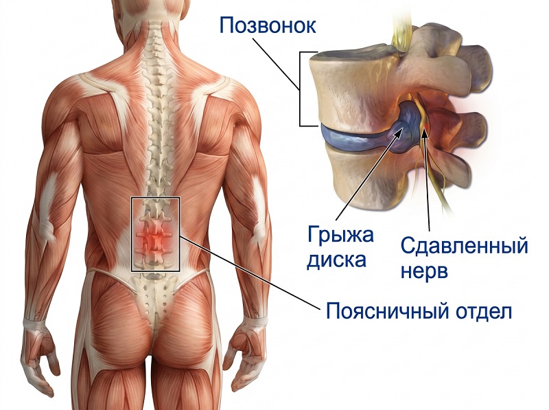 Радикулит поясничный