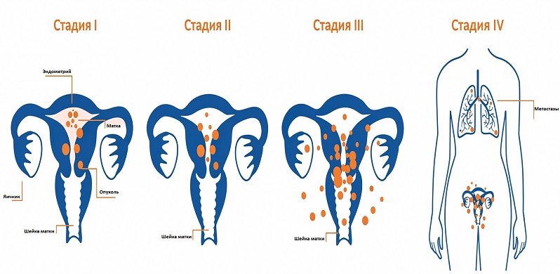 Cтадии рака матки