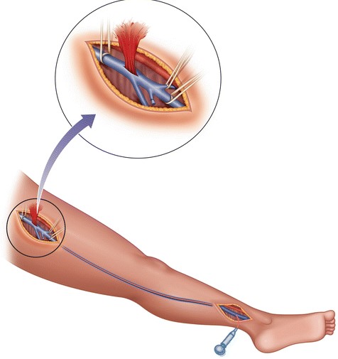 Химиотерапия при раке