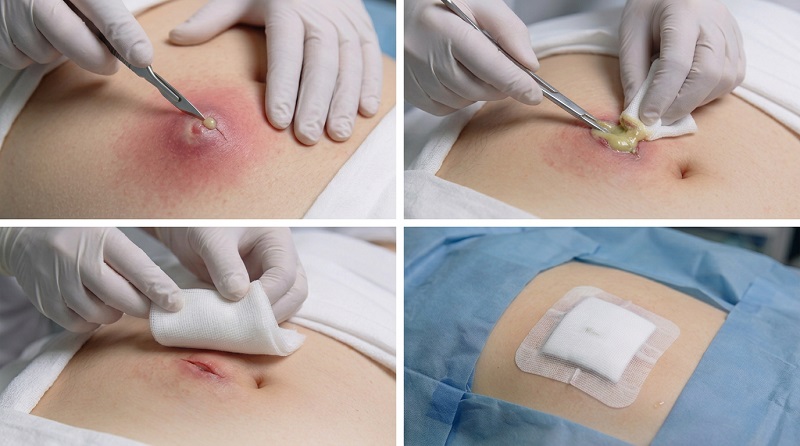 Вскрытие абсцесса